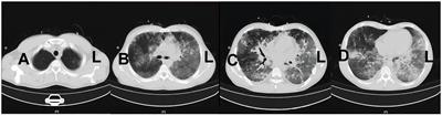 Early application of awake extracorporeal membrane oxygenation in pneumocystis jirovecii pneumonia complicated with severe acute respiratory distress syndrome: a case report